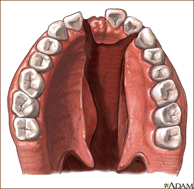 cleft palate defined 